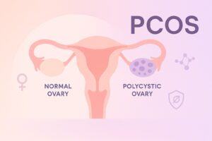 PCOS